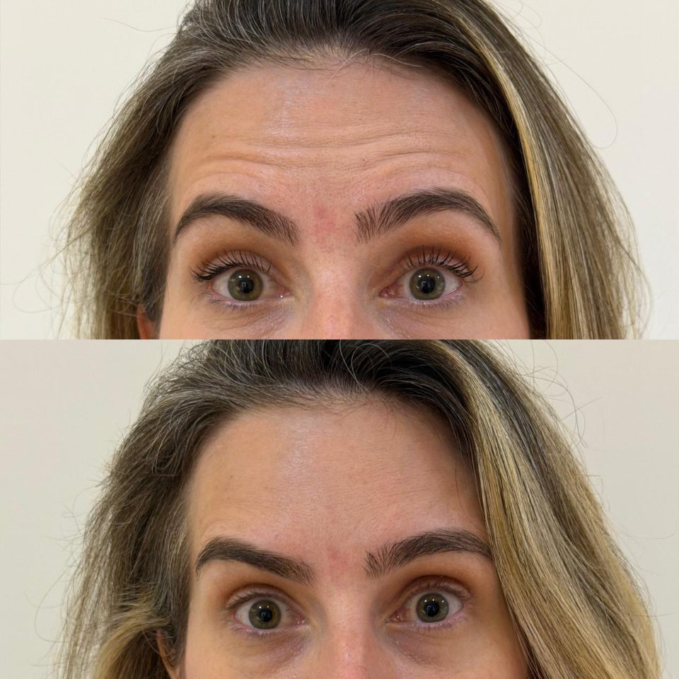 Antes e depois: toxina botulínica, testa