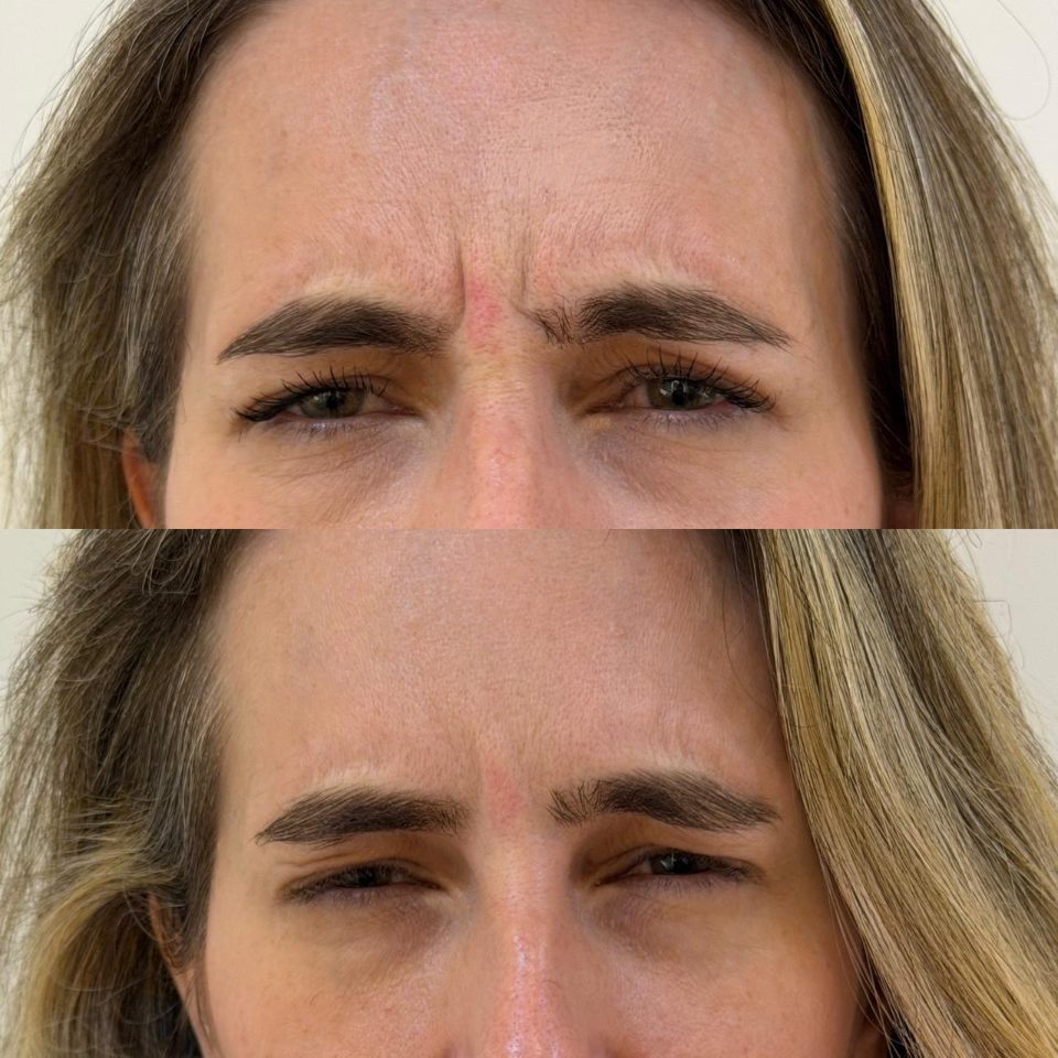 Antes e depois: toxina botulínica, entre as sobrancelhas