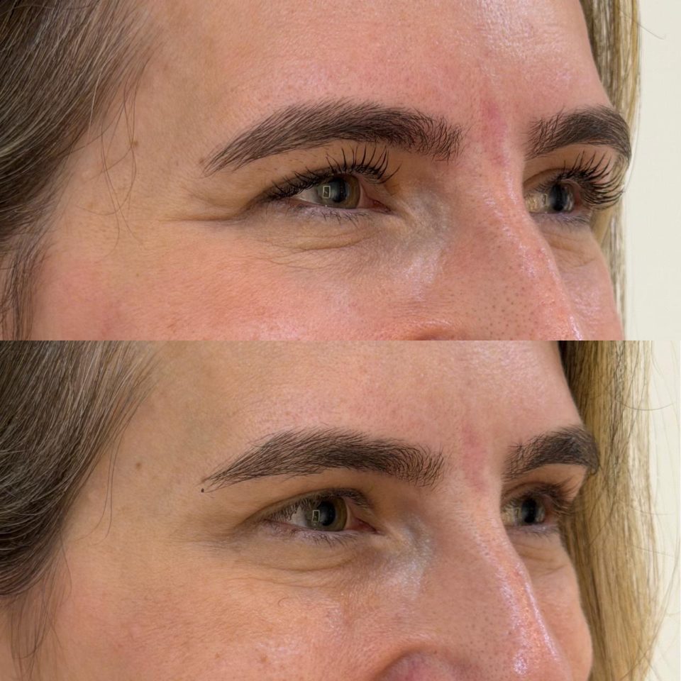 Antes e depois: toxina botulínica, ao redor dos olhos