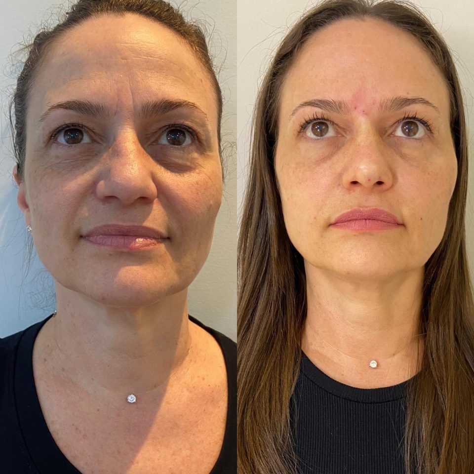 Antes e depois: harmonização facial, em repouso
