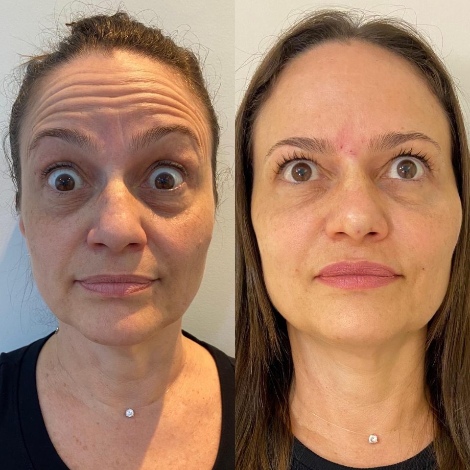 Antes e depois: harmonização facial, levantando as sobrancelhas
