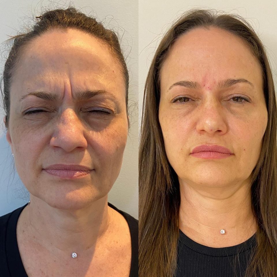 Antes e depois: harmonização facial, franzindo a testa