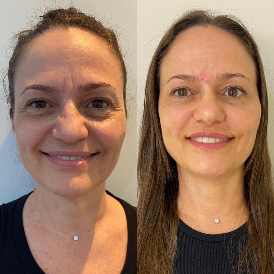 Antes e depois: harmonização facial, sorrindo