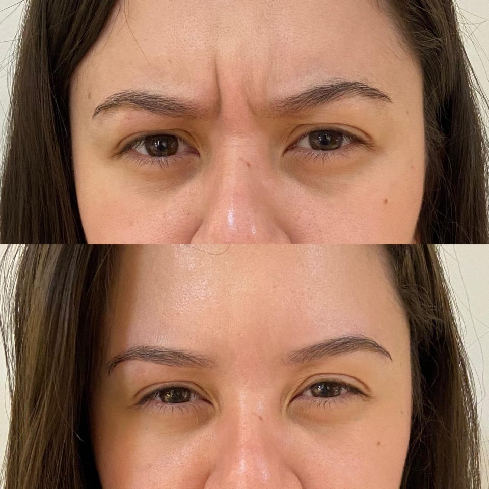 Antes e depois: toxina botulínica, entre as sobrancelhas
