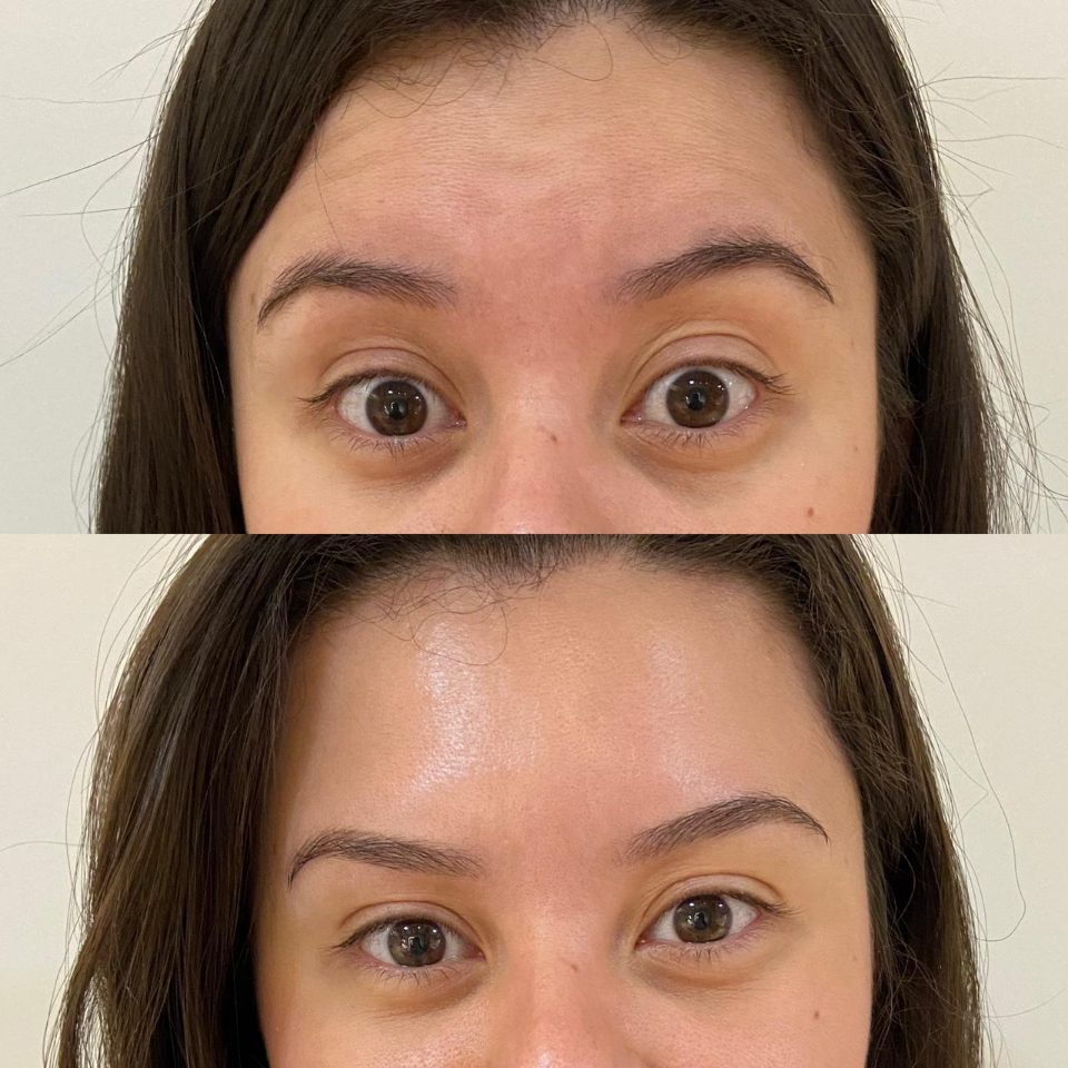 Antes e depois: toxina botulínica, testa