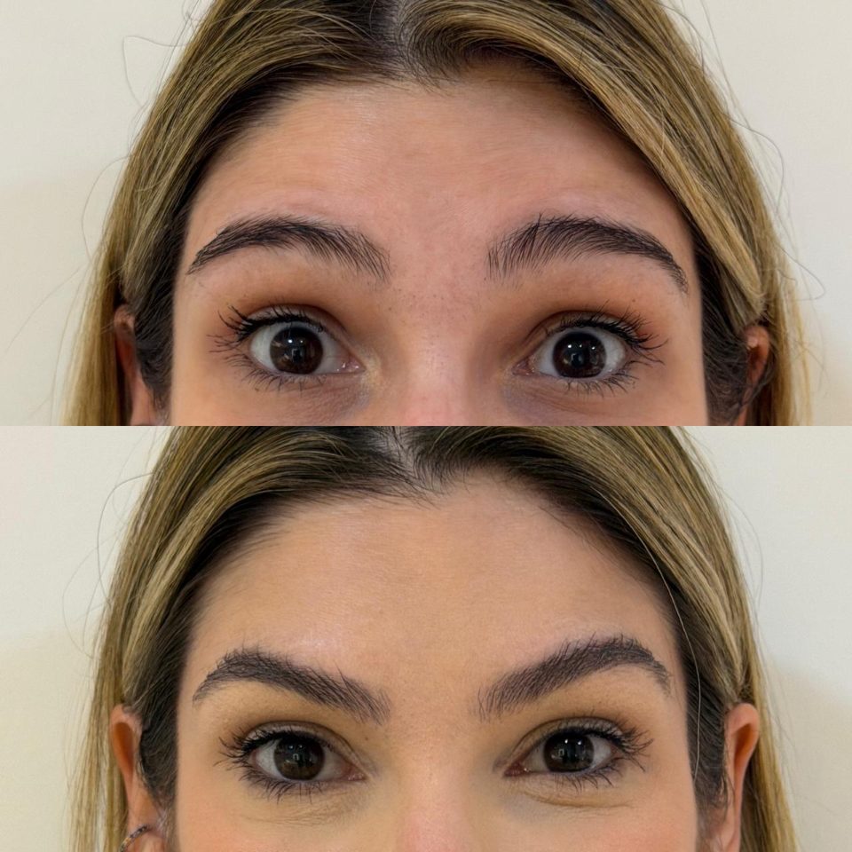 Antes e depois: toxina botulínica, testa