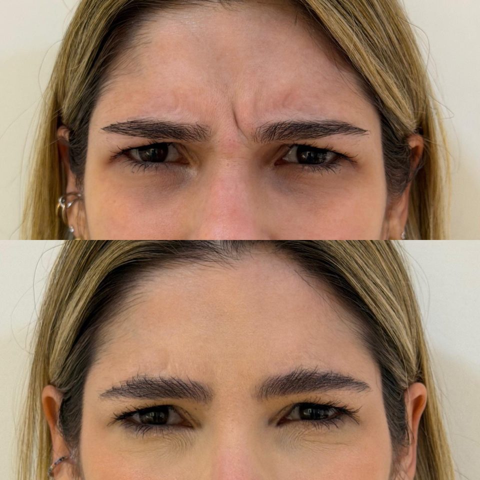Antes e depois: toxina botulínica, entre as sobrancelhas