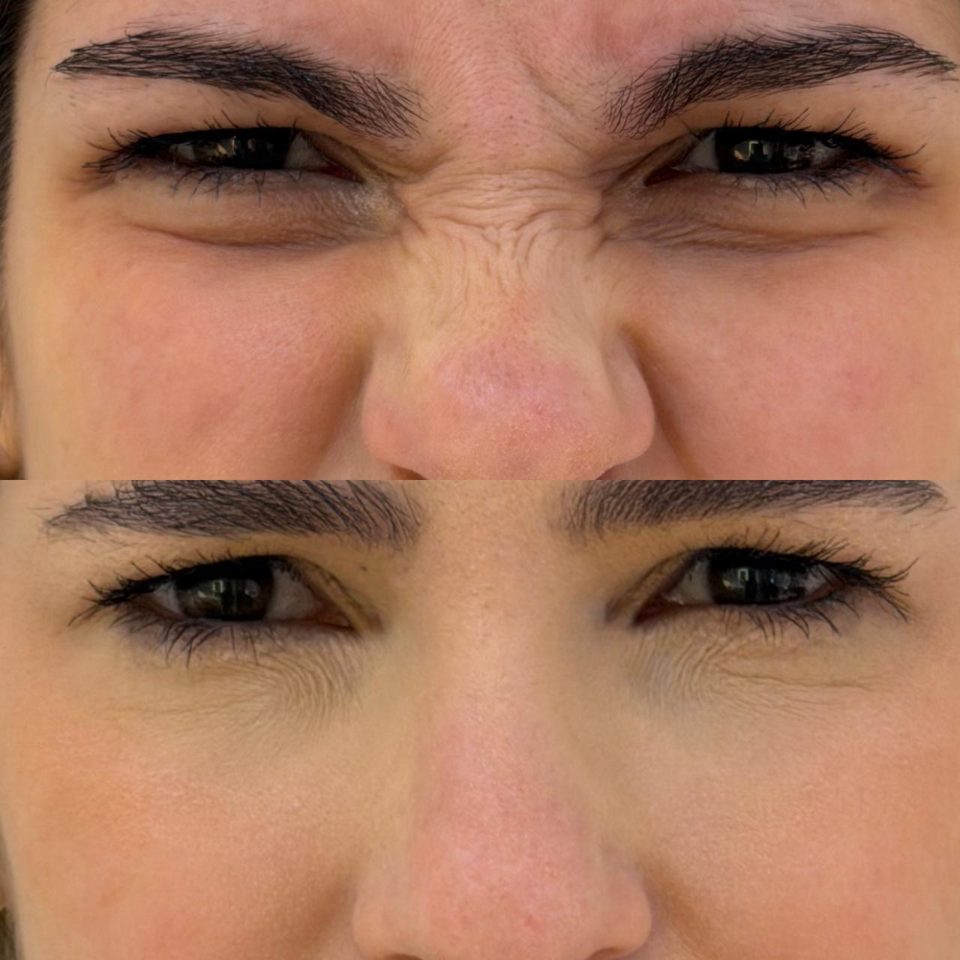 Antes e depois: toxina botulínica, nariz