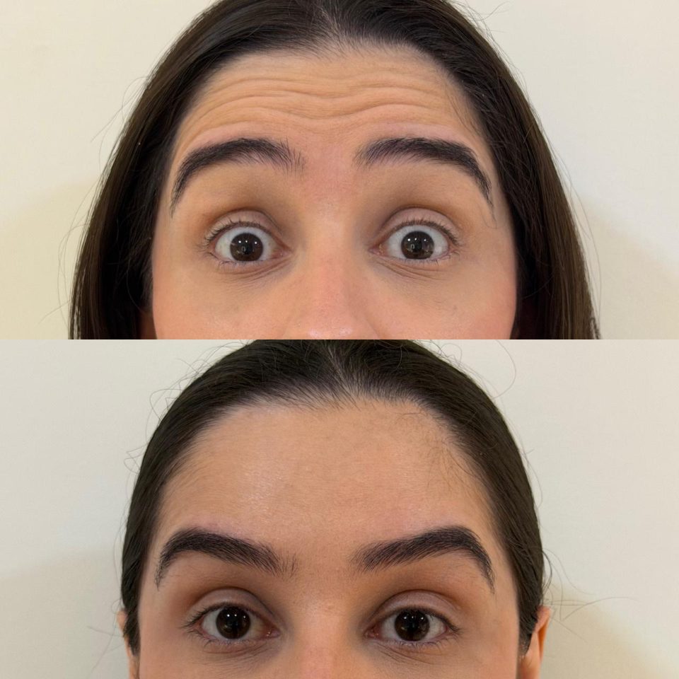 Antes e depois: toxina botulínica, testa