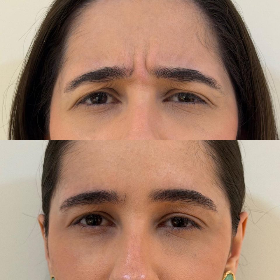Antes e depois: toxina botulínica, entre as sobrancelhas