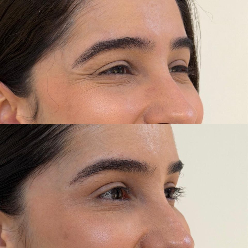 Antes e depois: toxina botulínica, ao redor dos olhos