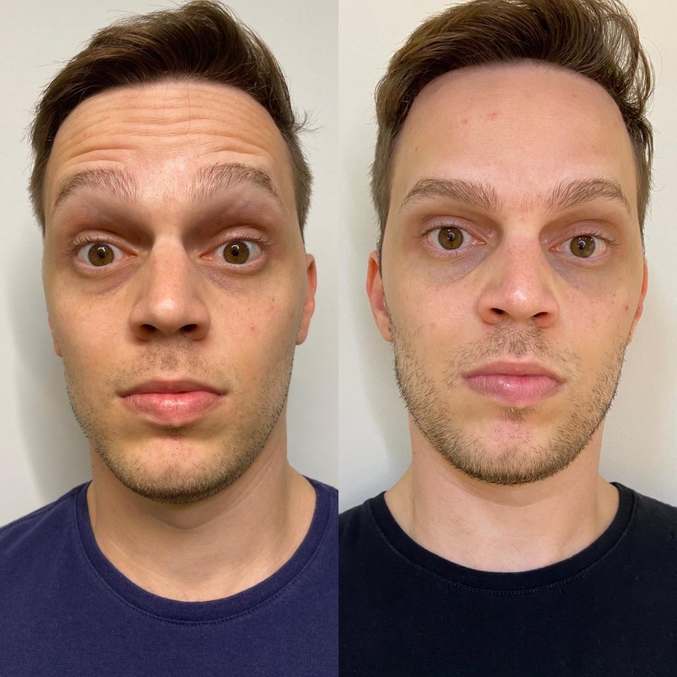 Antes e depois: toxina botulínica, testa