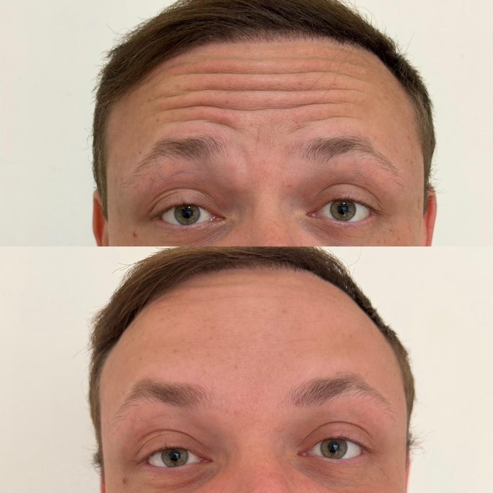 Antes e depois: toxina botulínica, testa
