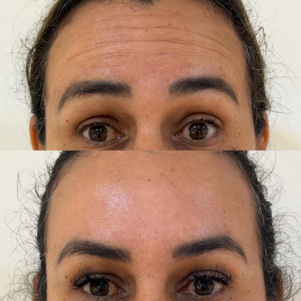 Antes e depois: toxina botulínica, testa