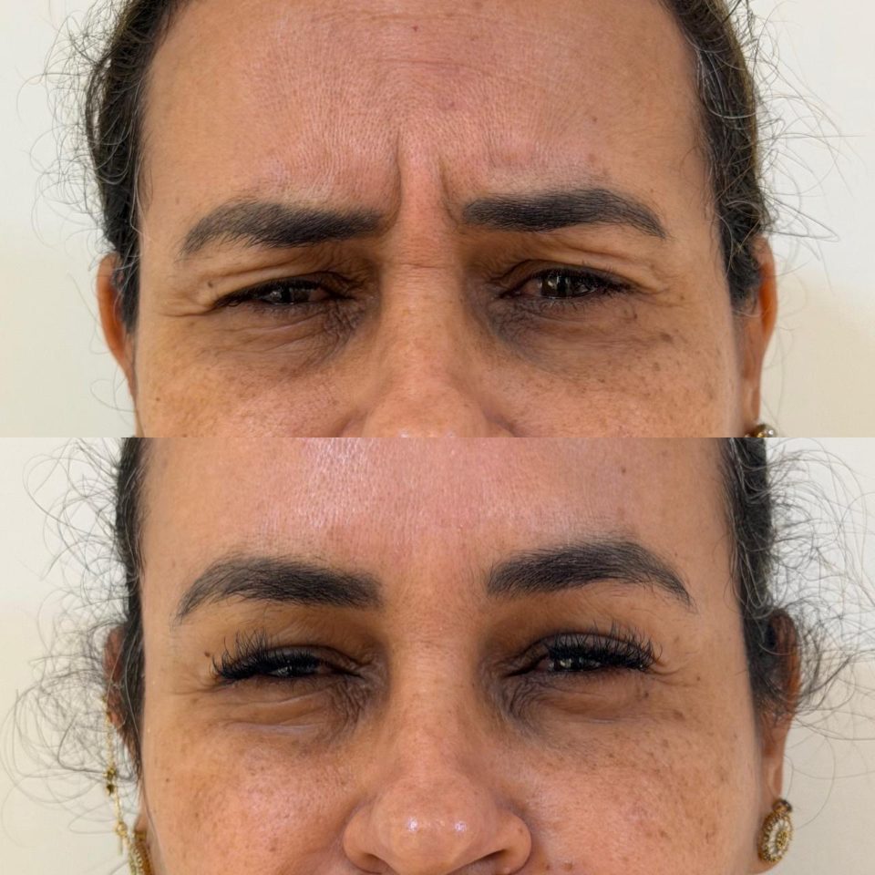 Antes e depois: toxina botulínica, entre as sobrancelhas