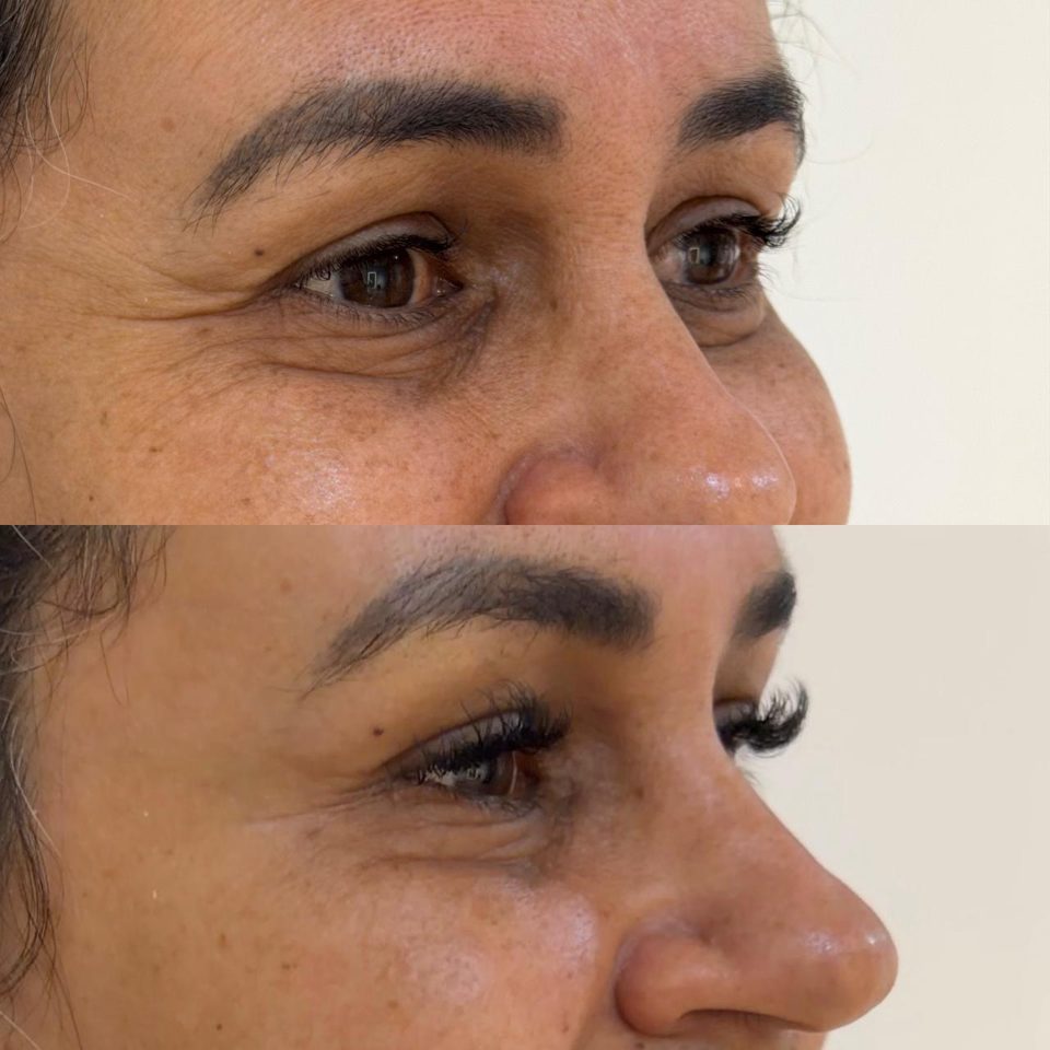 Antes e depois: toxina botulínica, ao redor dos olhos