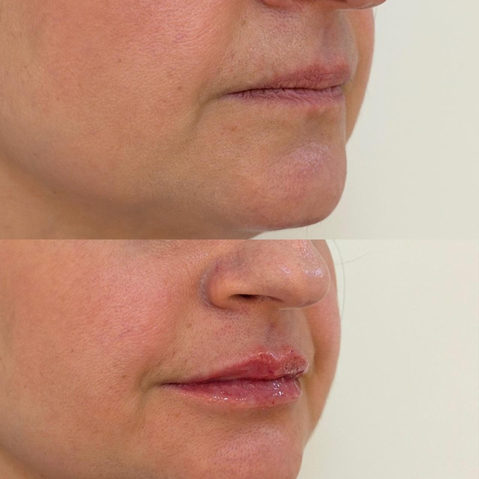 Antes e depois: preenchimento labial, lábios, de lado