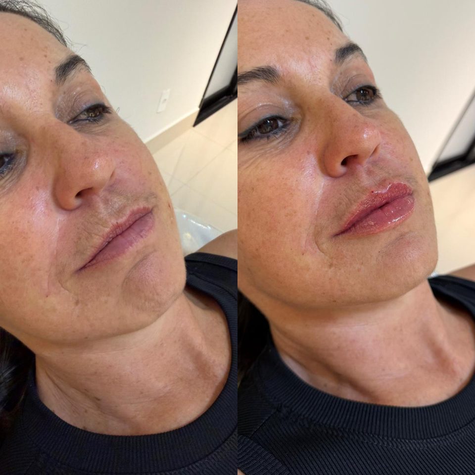 Antes e depois: preenchimento labial, lábios