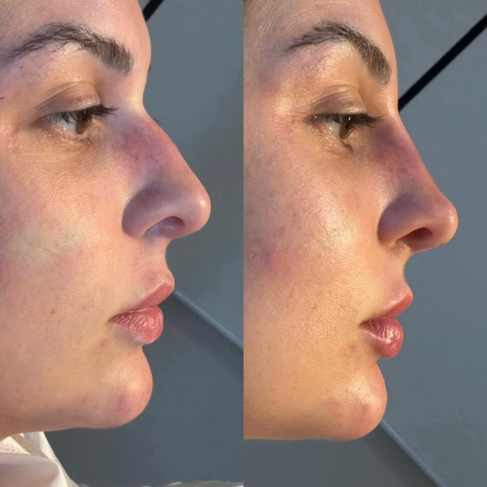 Antes e depois: rinomodelação, nariz, de perfil
