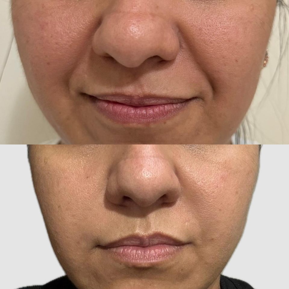 Antes e depois: harmonização facial, região da boca