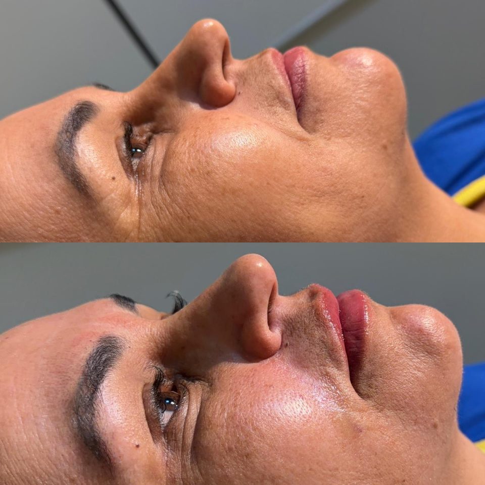 Antes e depois: preenchimento labial, lábios, de perfil